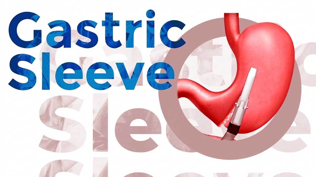 Gastric Sleeve weight Loss Calculator