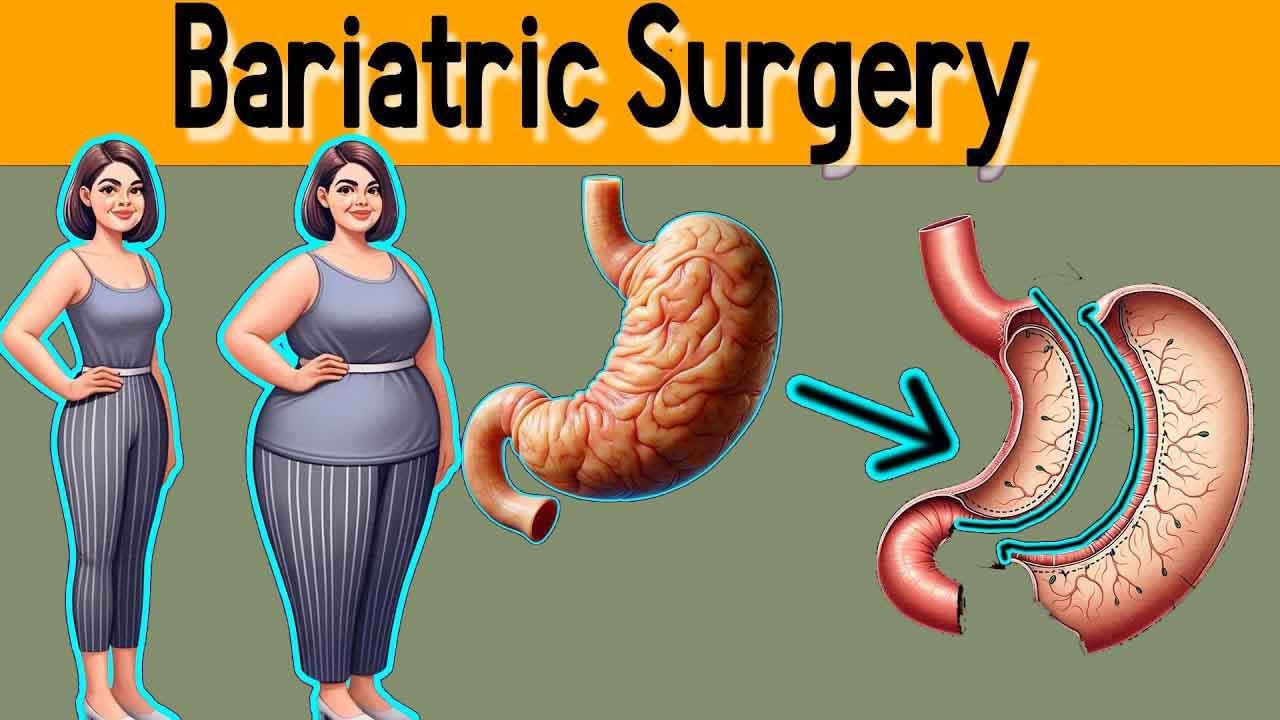 bariatric surgery weight loss calculator tool
